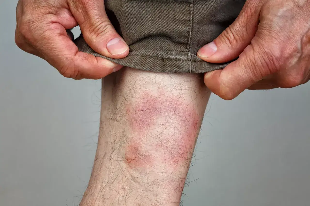 Rote Stelle am Bein nach Zeckenbiss. Wann zum Arzt? Hautirritation nach Insektenstich.