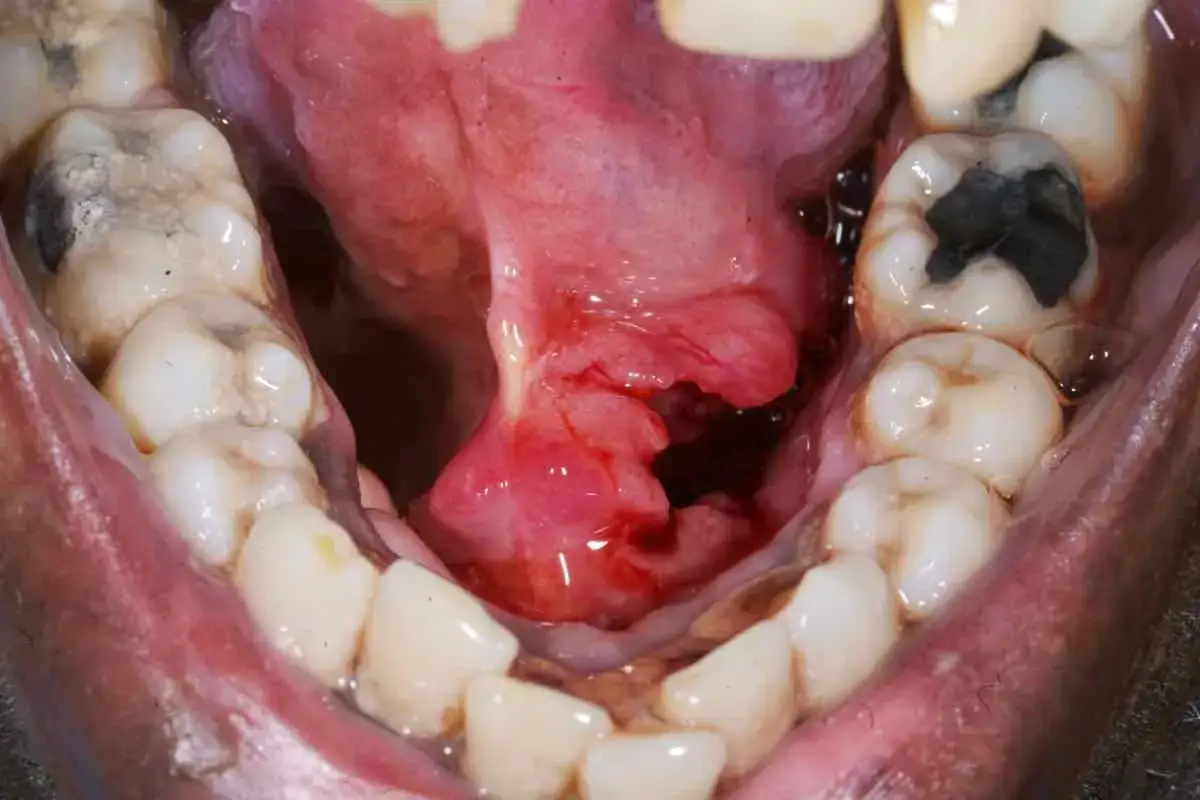 Lesi&oacute;n rojiza y abultada en la boca, con aspecto de ampolla debajo de la lengua, rodeada de dientes con caries.