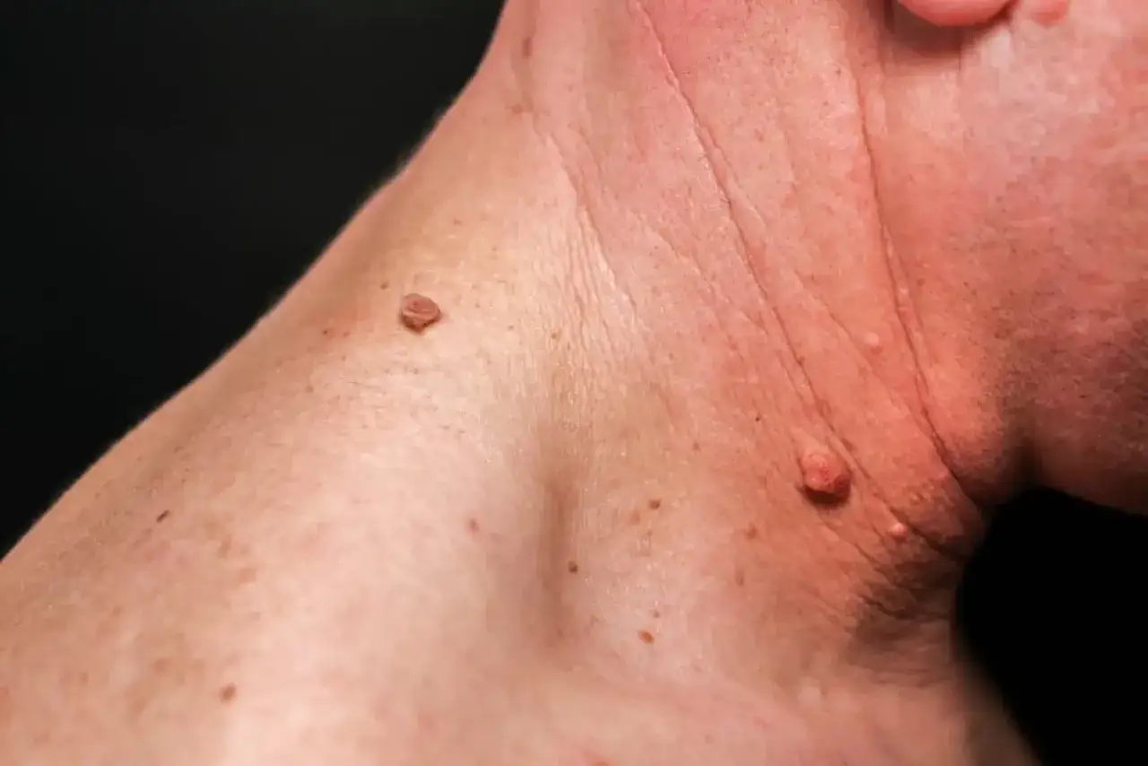 Gros plan sur le cou d'une personne, montrant plusieurs acrochordons et grains de beauté.