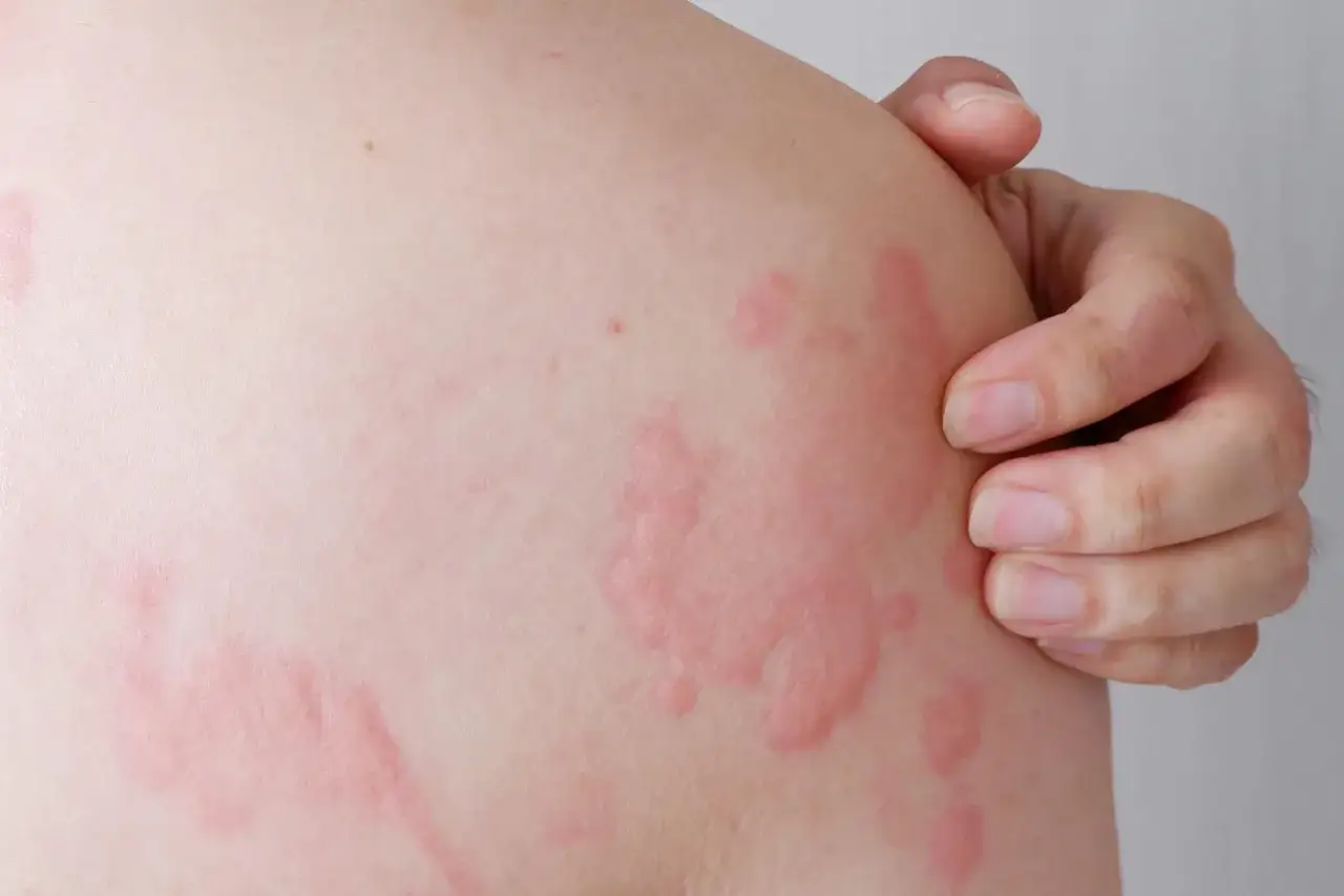 Pelle arrossata con pomfi, tipici dell'orticaria. Potrebbe essere un caso di orticaria bambini, che causa prurito e fastidio.