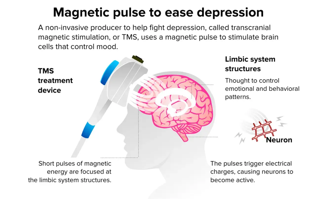 Illustration visar hur magnetbehandling, TMS, används för att stimulera hjärnan och lindra depression.