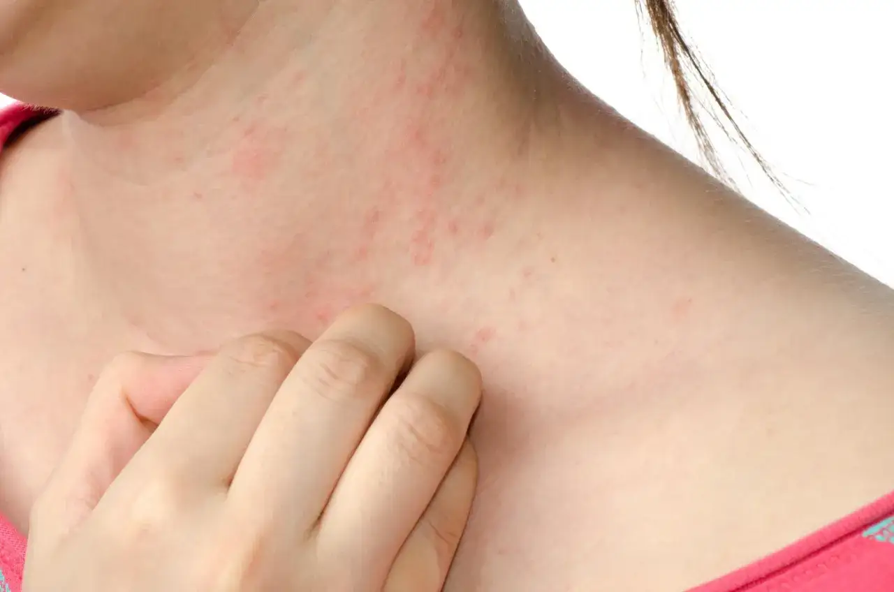 Roter Ausschlag am Hals und Dekolleté, juckt. Was tun bei Ausschlag durch neue Kleidung?