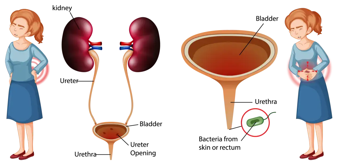 Illustration du système urinaire et d'une femme souffrant de douleurs. Elle montre des bactéries dans l'urètre, suggérant une infection. Combien de temps dure une infection urinaire sans traitement ?
