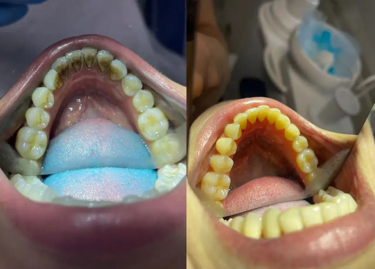 Przed i po zabiegu czyszczenia zębów u dentysty. Widać znaczącą różnicę w stanie uzębienia.