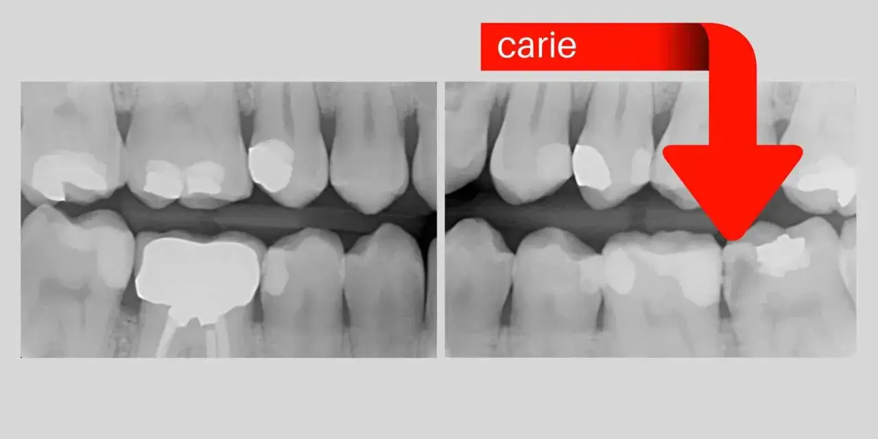 Radiografie dentali che mostrano una carie interna non visibile, evidenziata da una freccia rossa.
