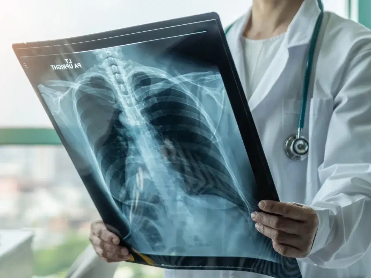 Lekarz analizuje zdjęcie RTG klatki piersiowej, szukając oznak odmy płucnej. Czy można umrzeć? Szybka diagnoza ratuje życie.