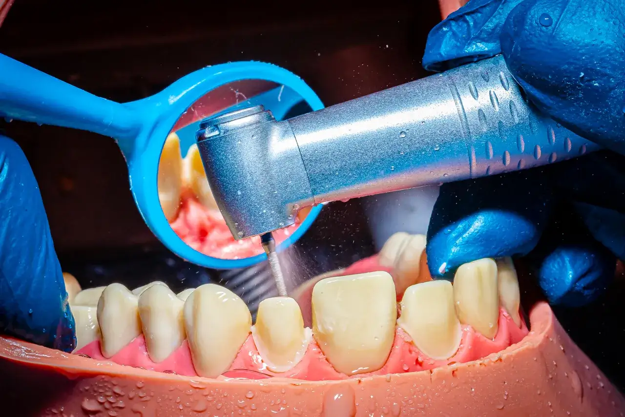 Precyzyjne szlifowanie zębów pod korony. Wiertło dentystyczne precyzyjnie modeluje ząb, przygotowując go do odbudowy protetycznej.