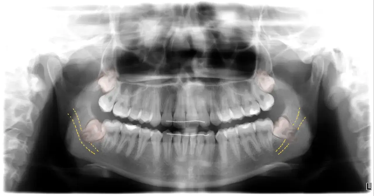 Radiograf&iacute;a panor&aacute;mica dental que muestra la posici&oacute;n de las muelas del juicio, algunas impactadas y marcadas con l&iacute;neas amarillas.