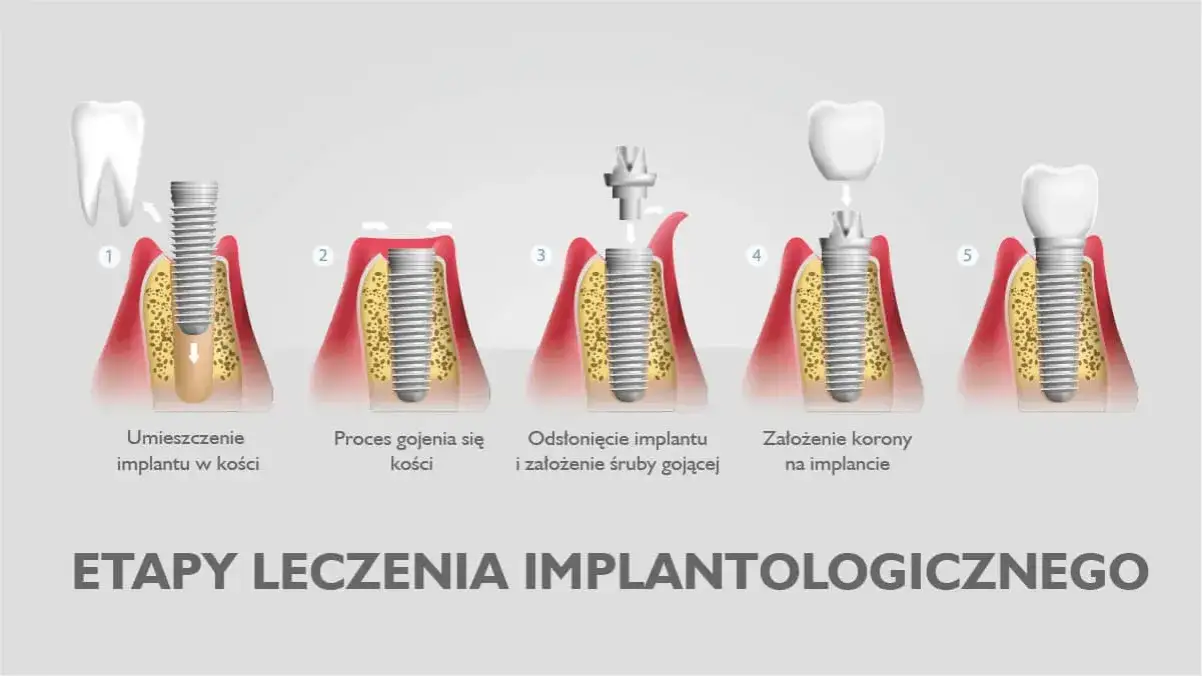 Rodzaje implantów zębowych porównanie