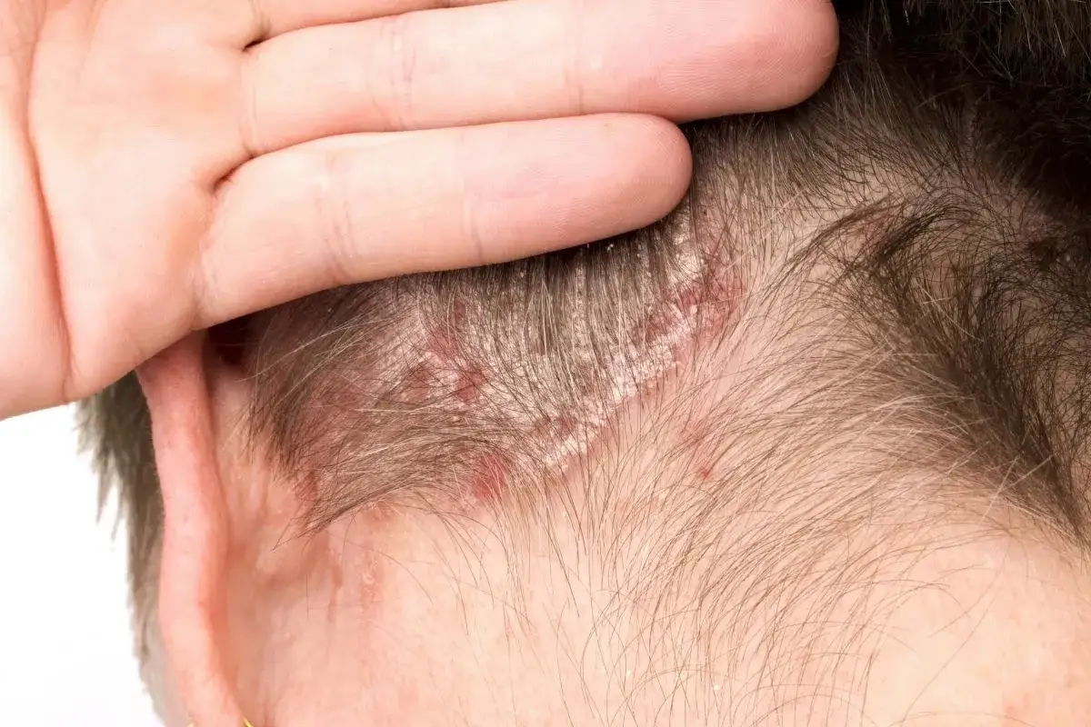 Main d'une personne touchant son cuir chevelu, r&eacute;v&eacute;lant des plaques rouges et squameuses, signe de psoriasis, souvent exacerb&eacute; par le stress.