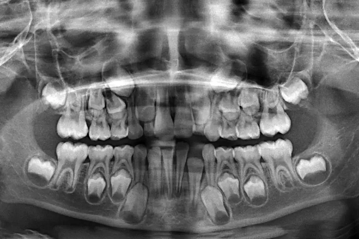 Radiografia panoramica che mostra agenesia dentale, con alcuni denti permanenti mancanti e altri in fase di sviluppo.
