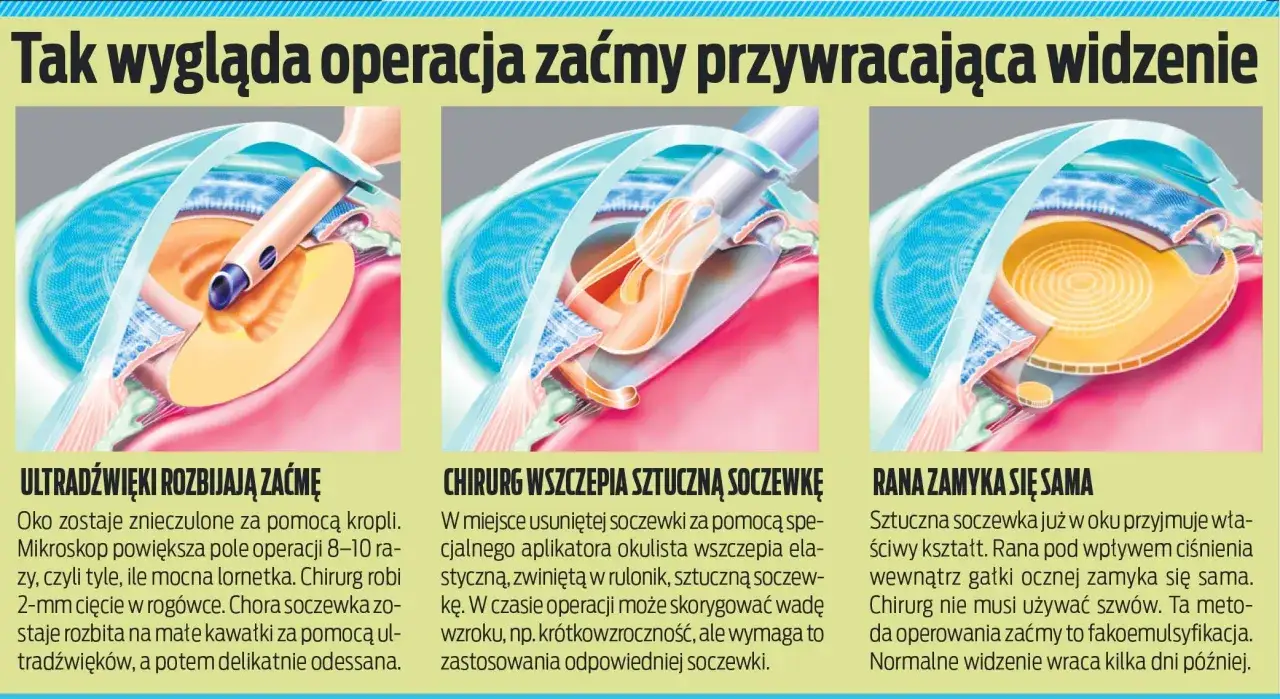 Ilustracja przedstawia operację zaćmy: ultradźwięki rozbijają zmętniałą soczewkę, wszczepiana jest sztuczna soczewka, a rana zamyka się sama.
