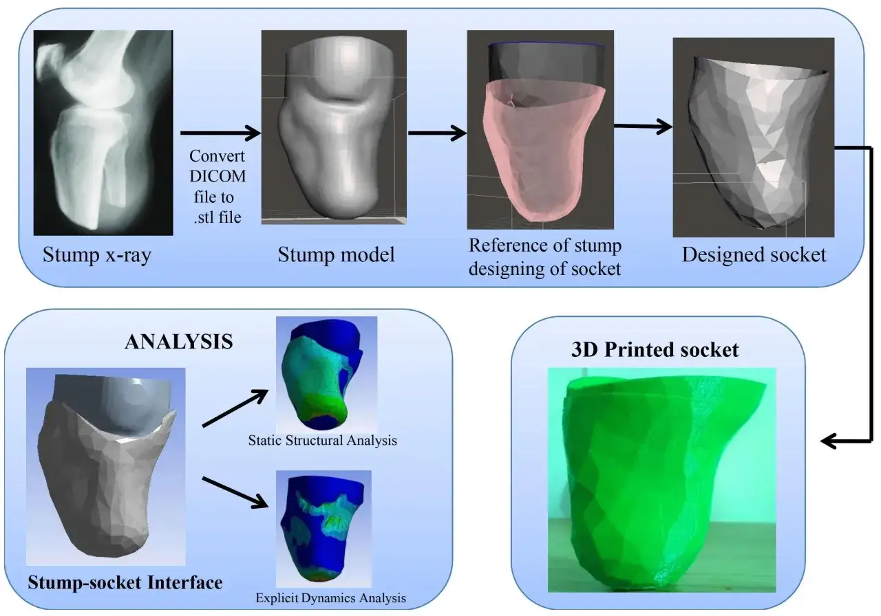 Processo di progettazione di una protesi: dall'RX del moncherino gamba al modello 3D e analisi strutturale.