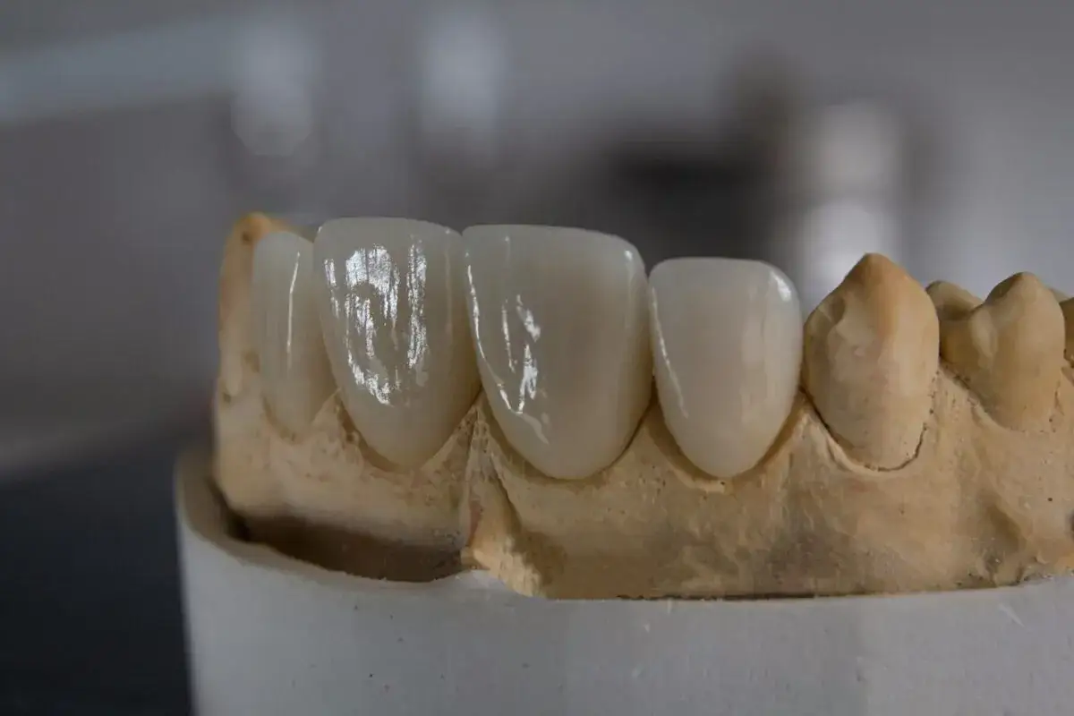 Model szczęki z pięknymi, lśniącymi zębami. Nowa korona porcelanowa czeka na dopasowanie.