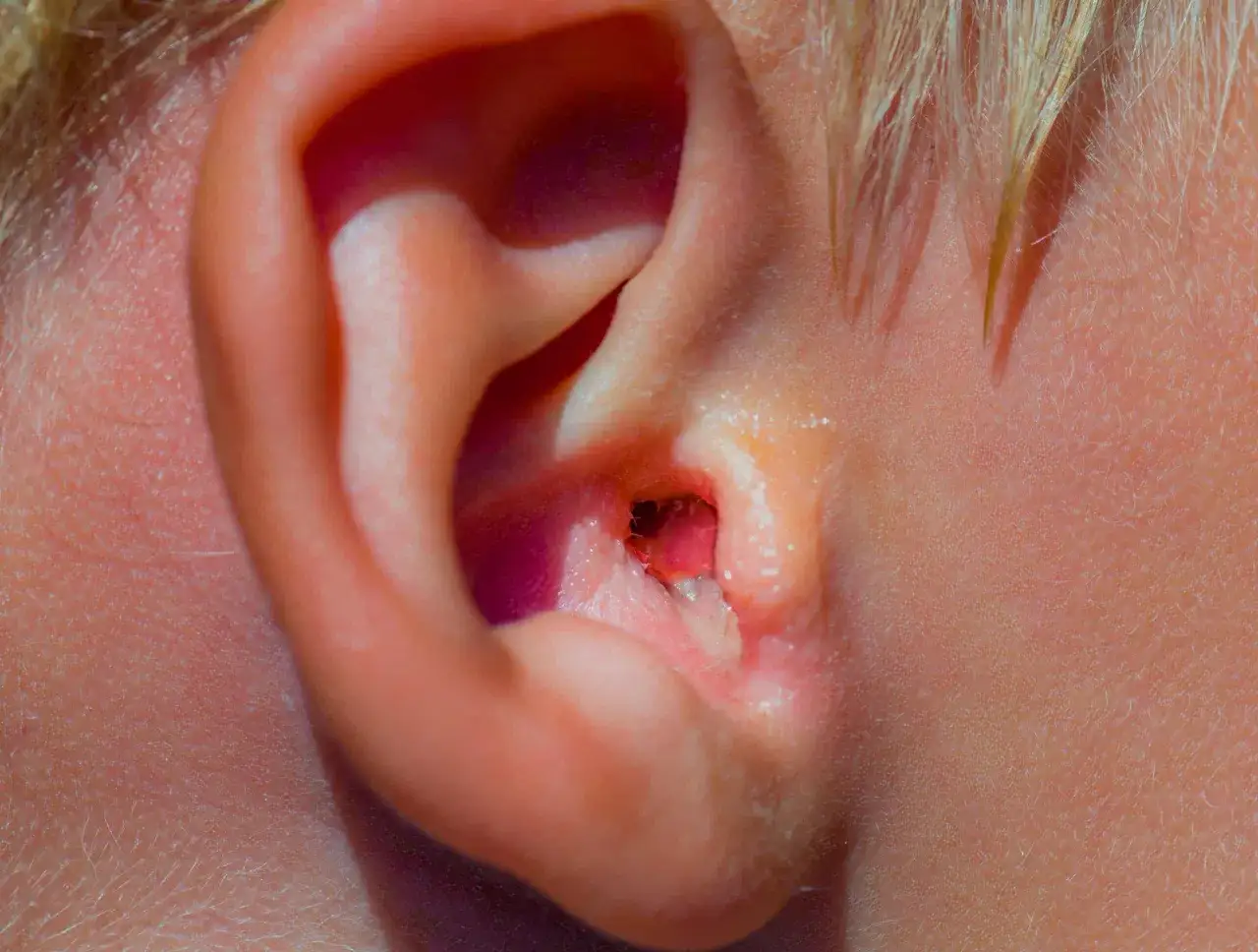 Oreille rouge et irritée, signe d'une otite du baigneur. Douleur et démangeaisons possibles.