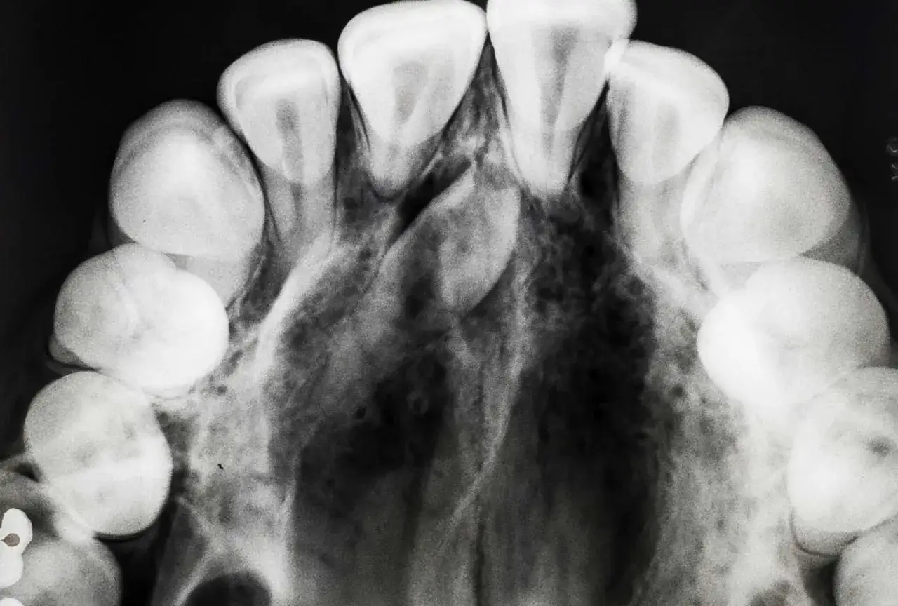 Radiografia mostra un dente che cresce sopra la gengiva, con altri denti visibili.