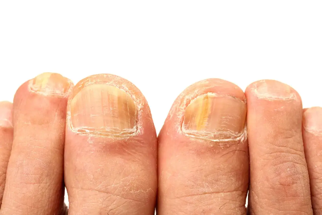 Dedos de los pies con uñas engrosadas y amarillentas, indicando tipos de hongos en los pies y cómo curarlos.