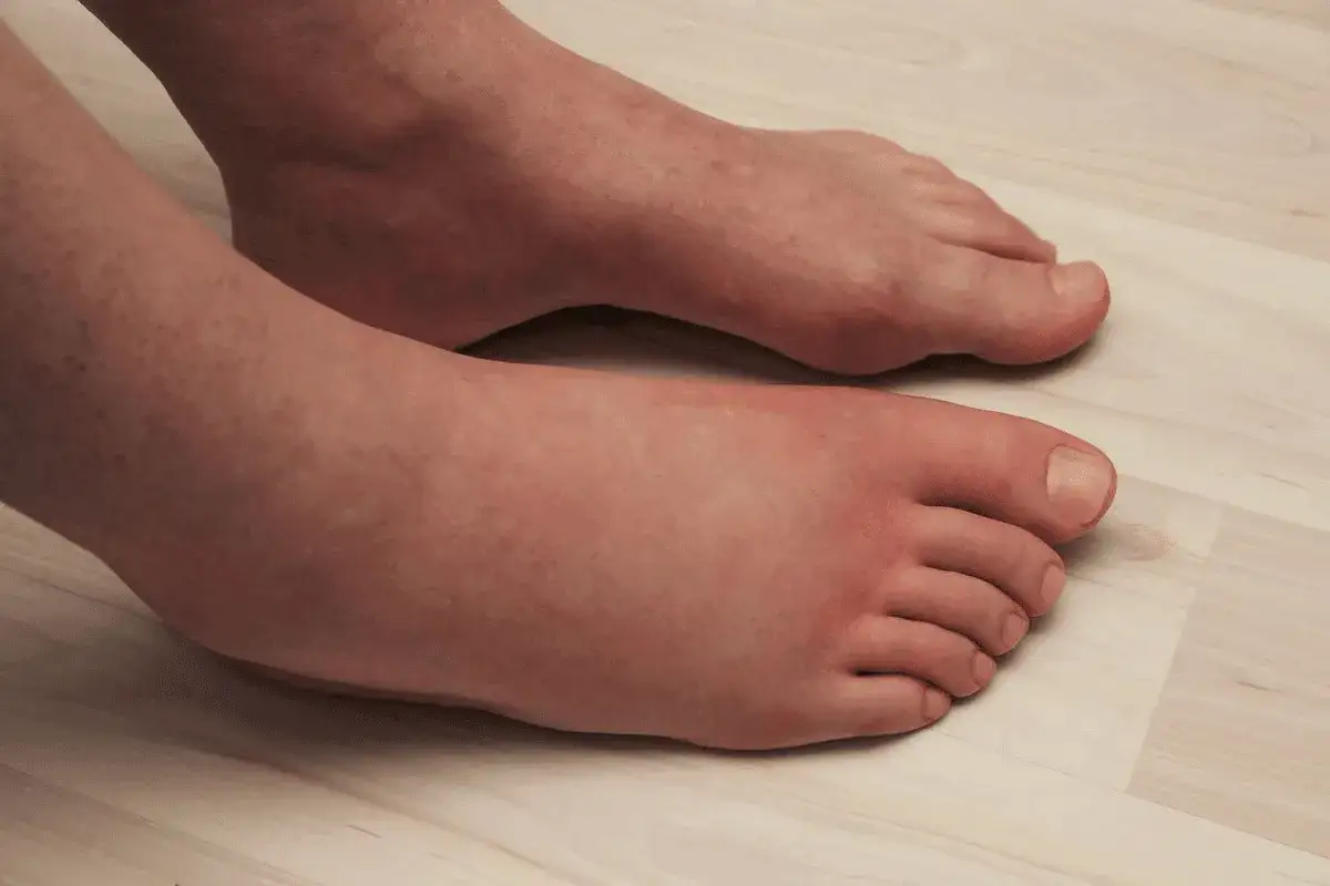 Geschwollene F&uuml;&szlig;e, ein m&ouml;gliches Zeichen f&uuml;r COPD und Wassereinlagerung.