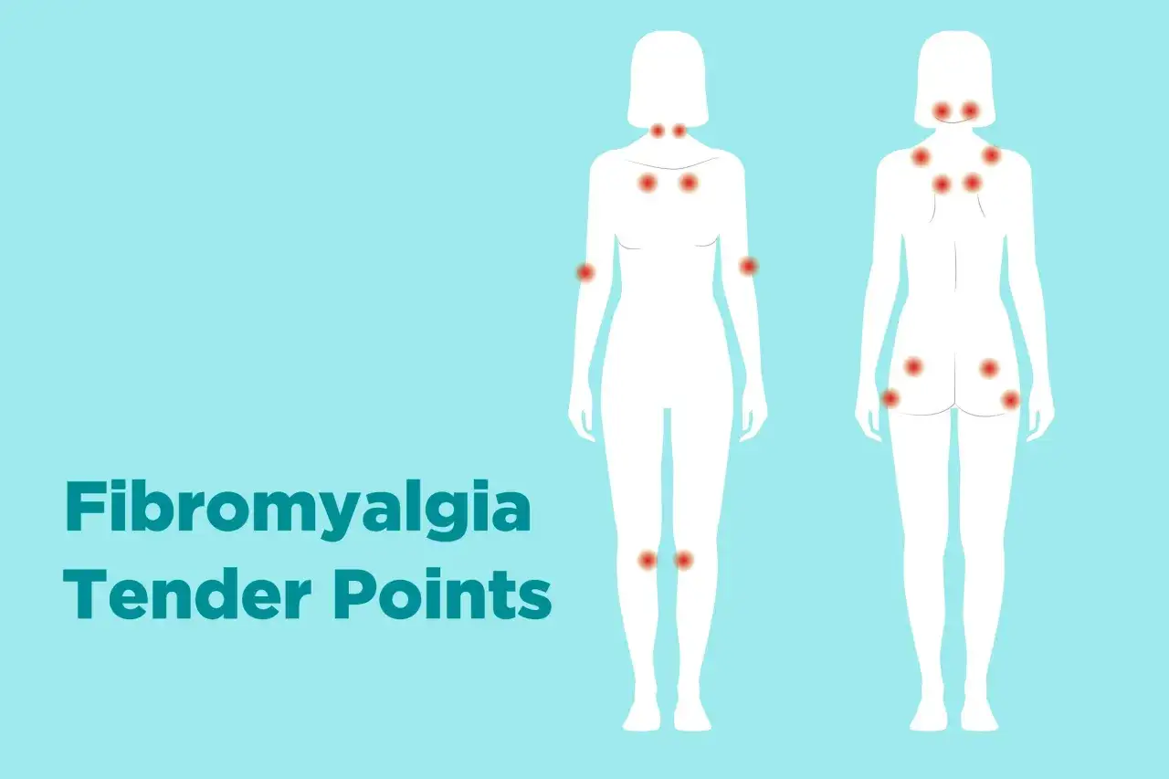 Grafika pokazuje punkty bólu związane z fibromialgią.