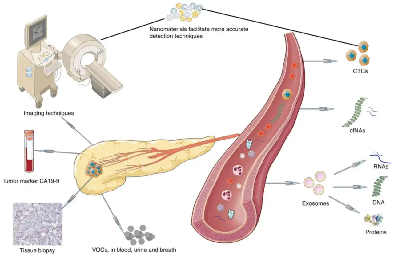 Ilustracja pokazuje r&oacute;żne metody diagnostyczne, w tym badania obrazowe, markery nowotworowe, biopsję tkanki, VOCs, CTCs, cfNAs, egzosomy, RNA, DNA i białka, kt&oacute;re pomagają w wykrywaniu chor&oacute;b trzustki.