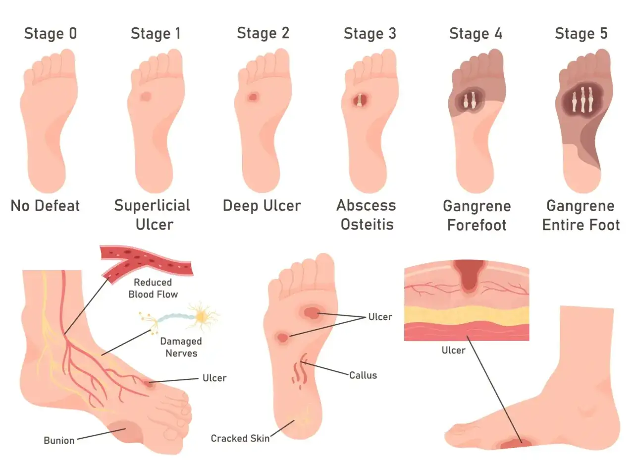 Illustrazione delle fasi di un'ulcera alle gambe, da superficiale a gangrena. Mostra anche cause come ridotto flusso sanguigno e nervi danneggiati.