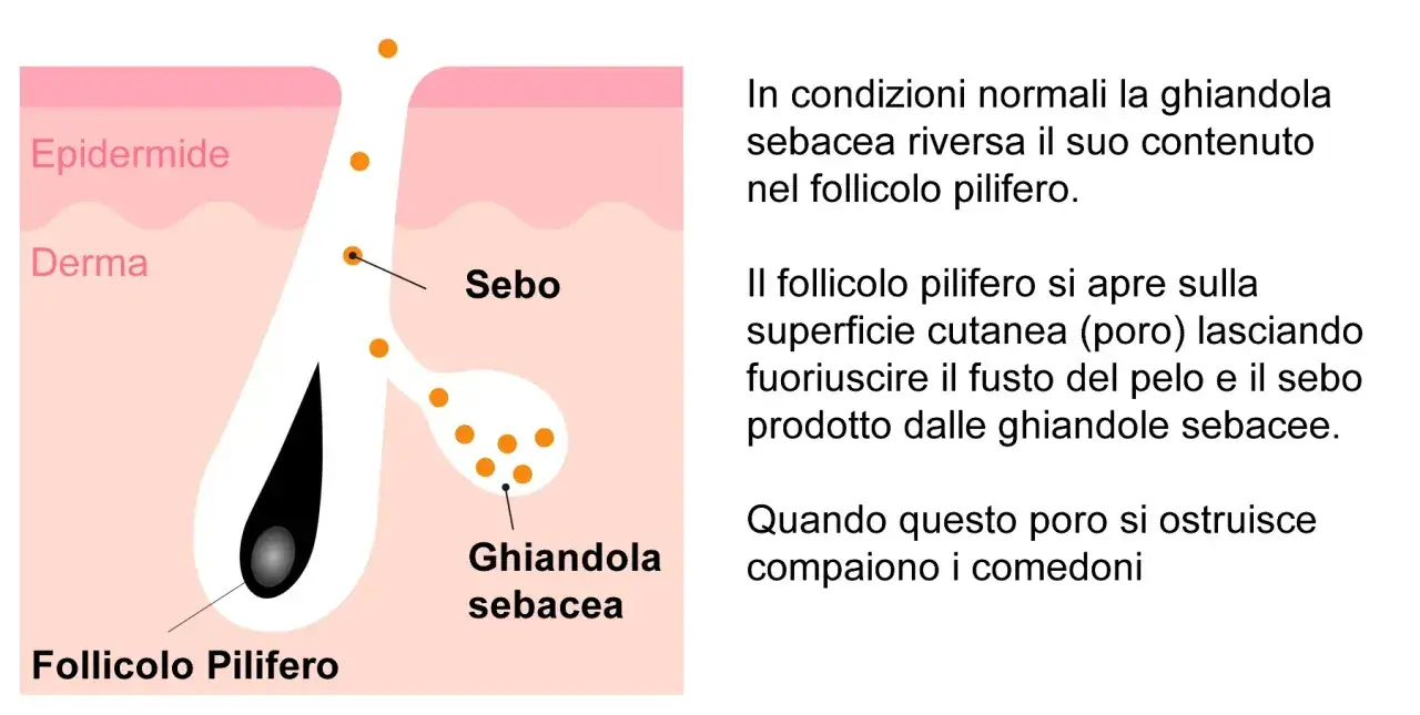 Illustrazione anatomica della pelle: il sebo prodotto dalla ghiandola sebacea non riesce a uscire dal follicolo pilifero, formando un punto nero.