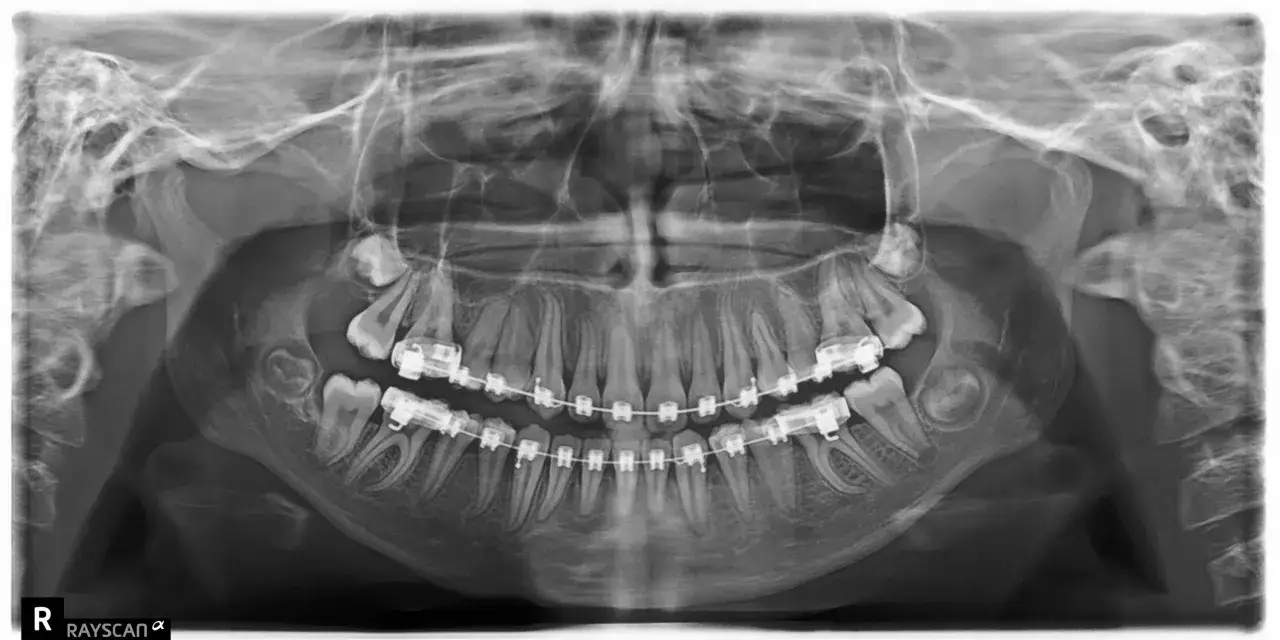 Rentgen szczęki z aparatem ortodontycznym. Czy cbct to to samo? Nie, cbct to tomografia komputerowa wiązki stożkowej.
