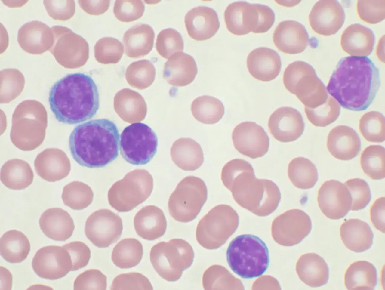 Linfociti atipici, alcuni con nucleo lobulato, tra globuli rossi. Potrebbe trattarsi di leucemia linfatica cronica.