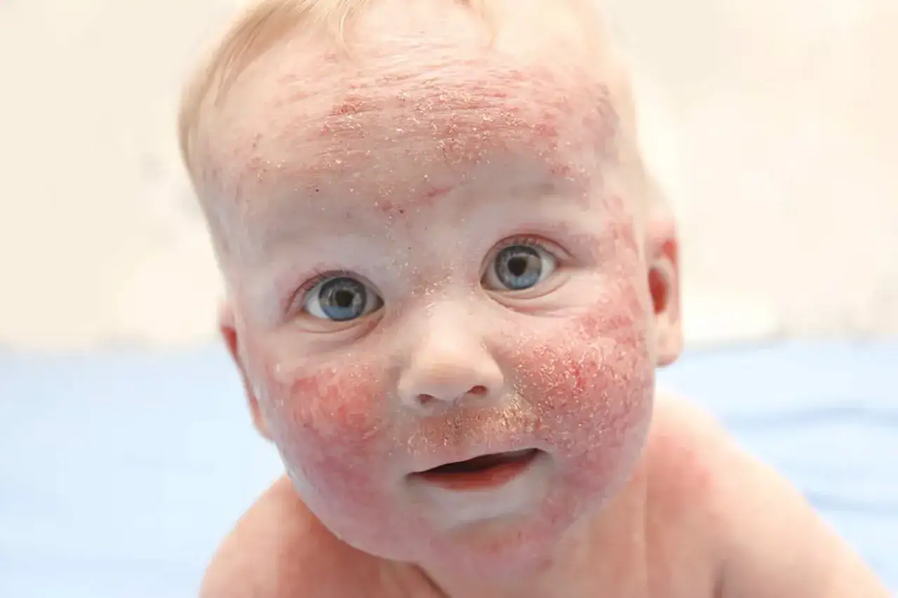Primo piano di un neonato con pelle arrossata e squamosa sul viso, segno di inizio dermatite atopica neonato.