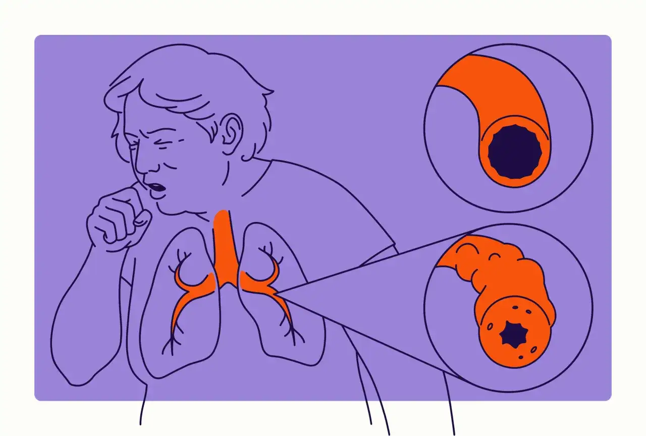 Illustration zeigt eine Person, die hustet, mit verengten Atemwegen, die das COPD-Krankheitsbild verdeutlichen.