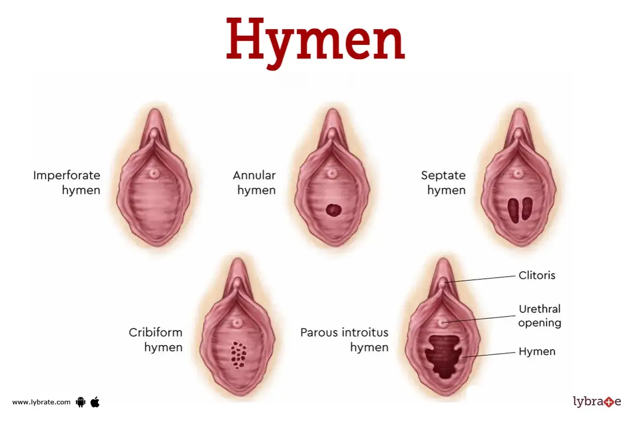 Różne rodzaje błony dziewiczej: imperforata, annular, septate, cribiform, parous introitus. Hymen co to?