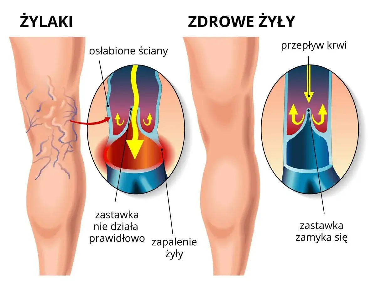 Ilustracja porównuje zdrowe żyły z żylakami, pokazując osłabione ściany i niewydolne zastawki, które prowadzą do zapalenia żył.