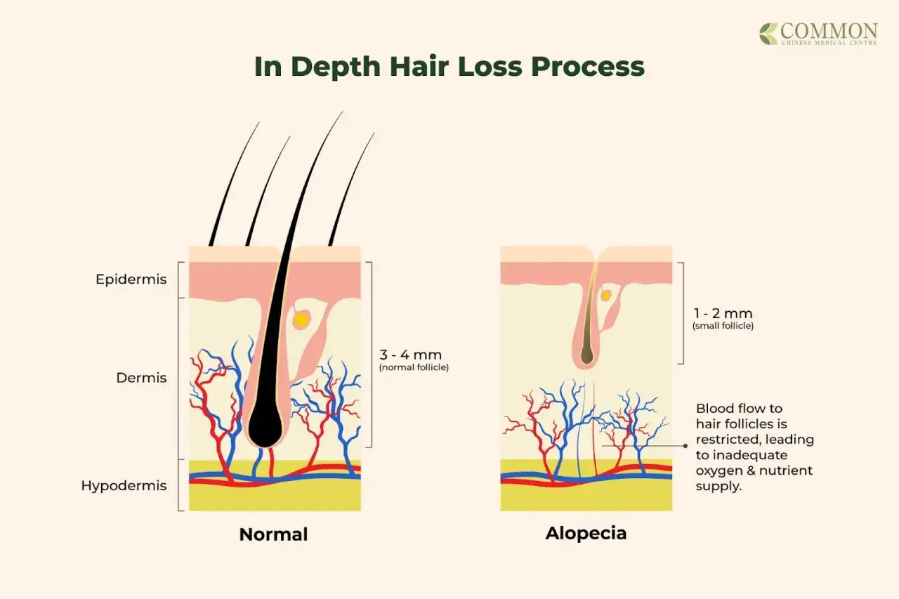 Comparaci&oacute;n de fol&iacute;culos pilosos: uno normal, con buen flujo sangu&iacute;neo para **crecer pelo**, y otro con alopecia, donde el flujo sangu&iacute;neo reducido limita el crecimiento.
