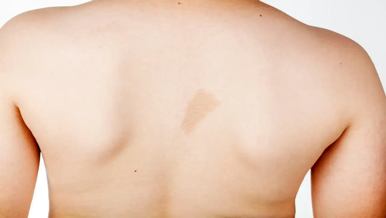 Plama kawowa na plecach, jeden z objawów neurofibromatozy.