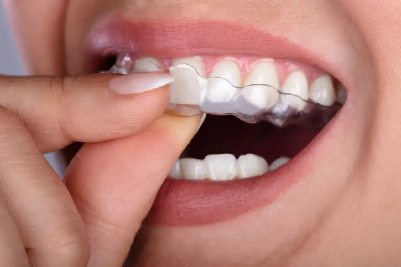 Dłoń zakłada przezroczystą nakładkę na zęby, co jest częścią leczenia bruksizmu.
