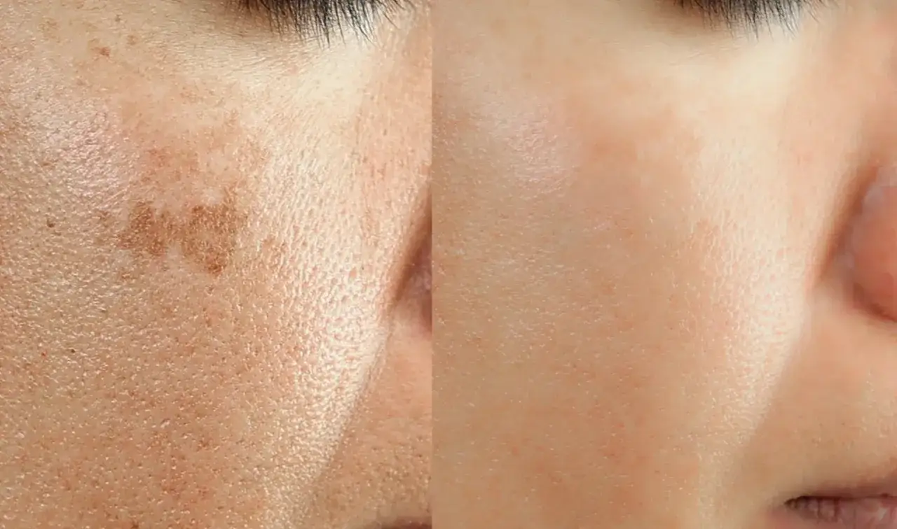 Comparación de piel: antes con manchas melasma y después de tratamiento, mostrando una piel más uniforme y clara.