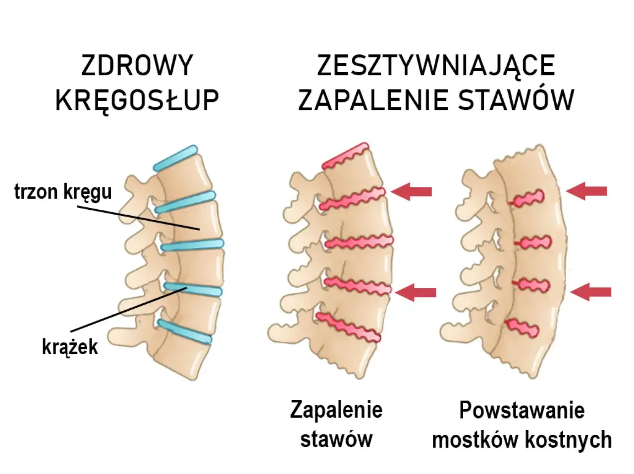 Zdrowy kręgosłup vs. ZZSK: zapalenie stawów prowadzi do powstawania mostków kostnych, usztywniając kręgosłup.