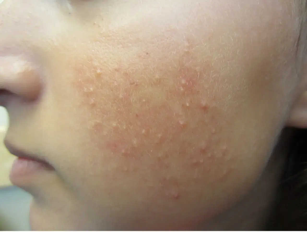 N&auml;rbild p&aring; en persons ansikte med sm&aring;, r&ouml;da upph&ouml;jningar som tyder p&aring; keratosis pilaris.