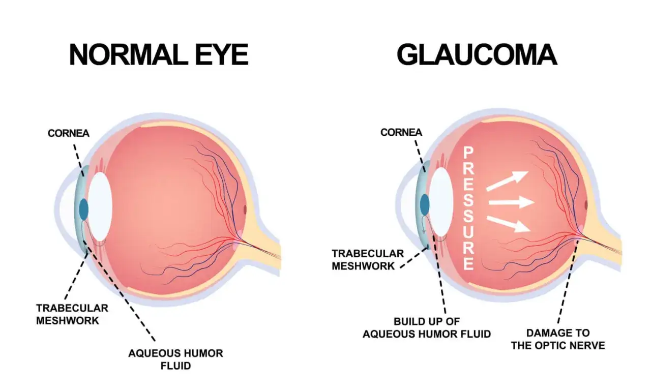 Occhio normale vs. occhio con glaucoma, con indicazione di pressione e danno al nervo ottico. Laser SLT controindicazioni da valutare.