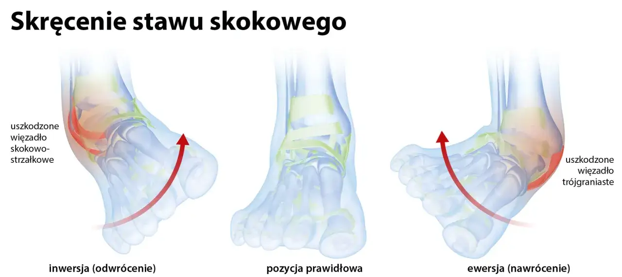 Ilustracja pokazuje inwersję stopy, czyli odwrócenie, gdzie uszkodzone jest więzadło skokowo-strzałkowe. Obok pozycja prawidłowa i ewersja.