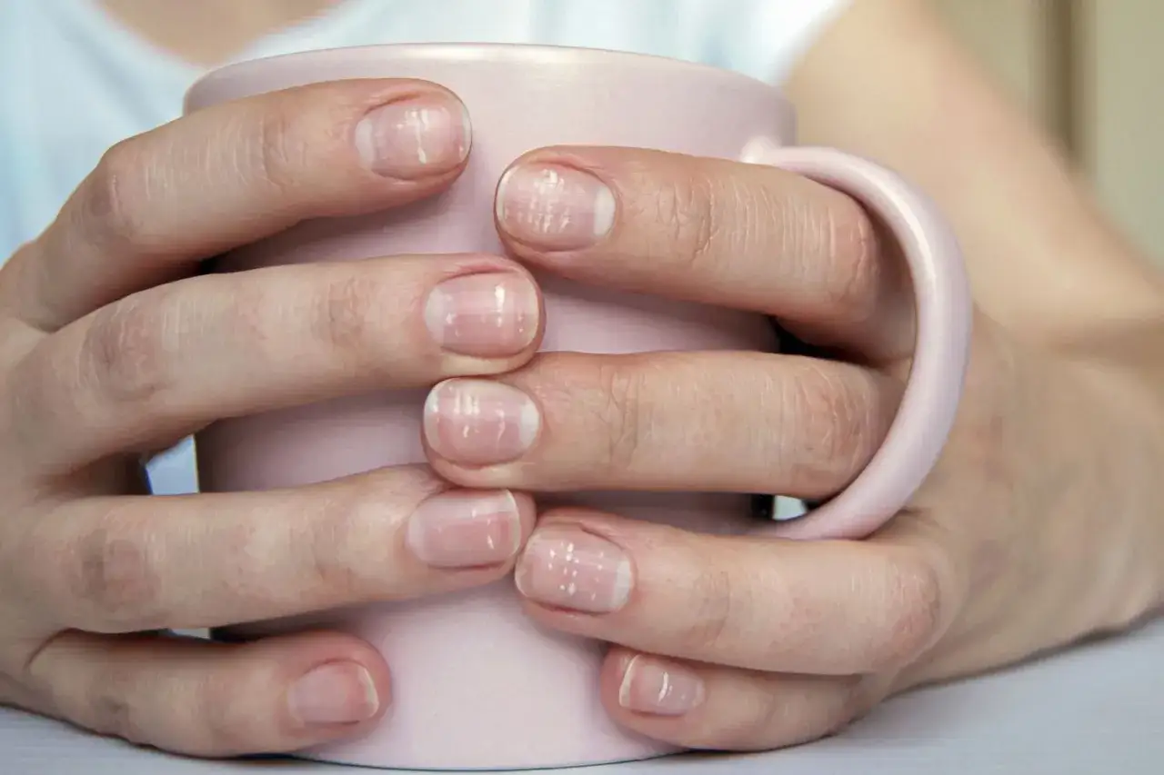 Mains tenant une tasse rose, les ongles présentent des lignes blanches, un signe d'ongle blanc.