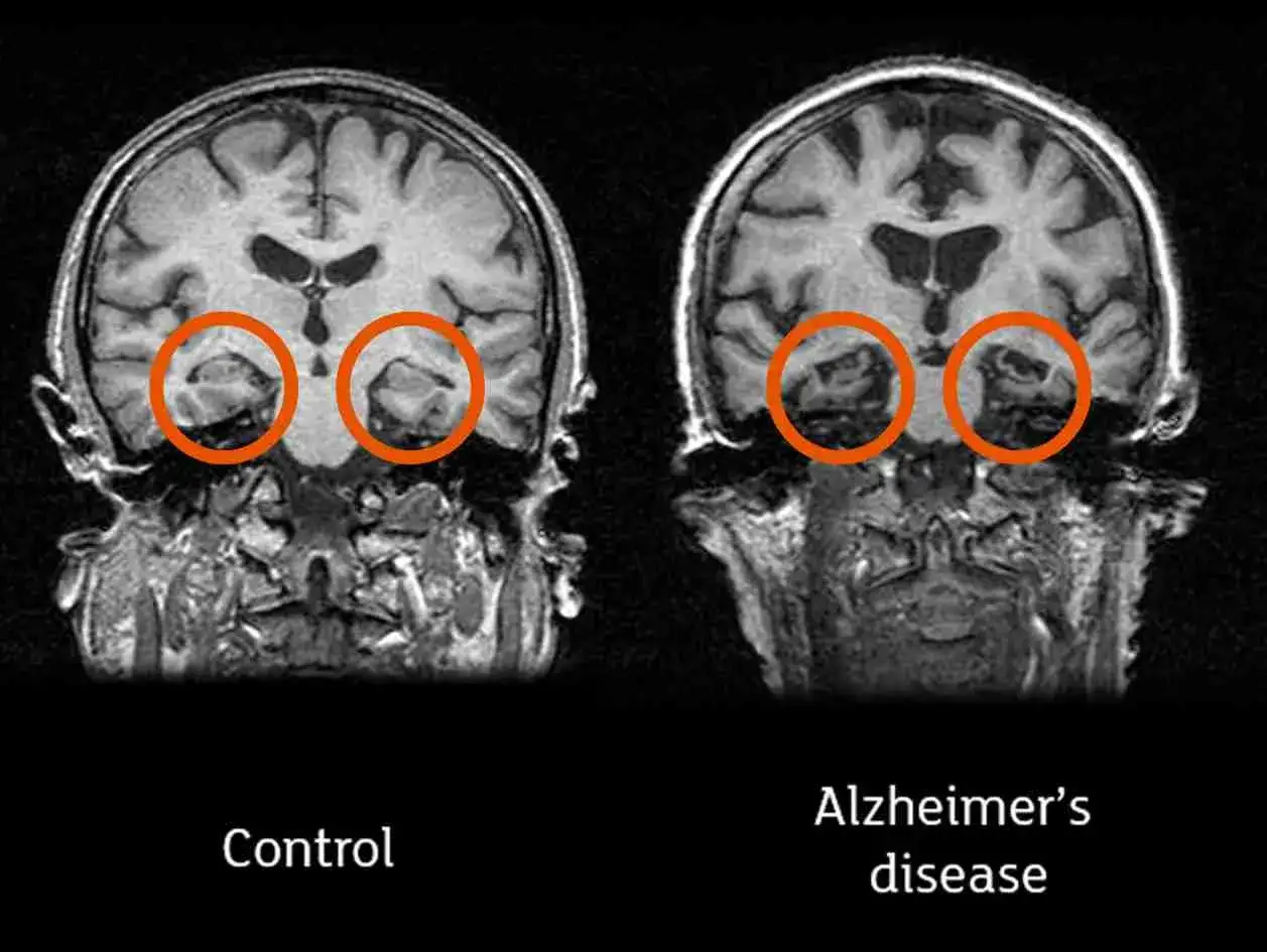 Porównanie rezonansu mózgu: hipokamp u osoby zdrowej (Control) i z chorobą Alzheimera. Widoczne zmniejszenie hipokampa, kluczowego w teście na Alzheimera.
