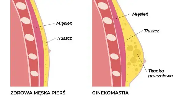 mechanizm działania tamoksyfenu ginekomastia