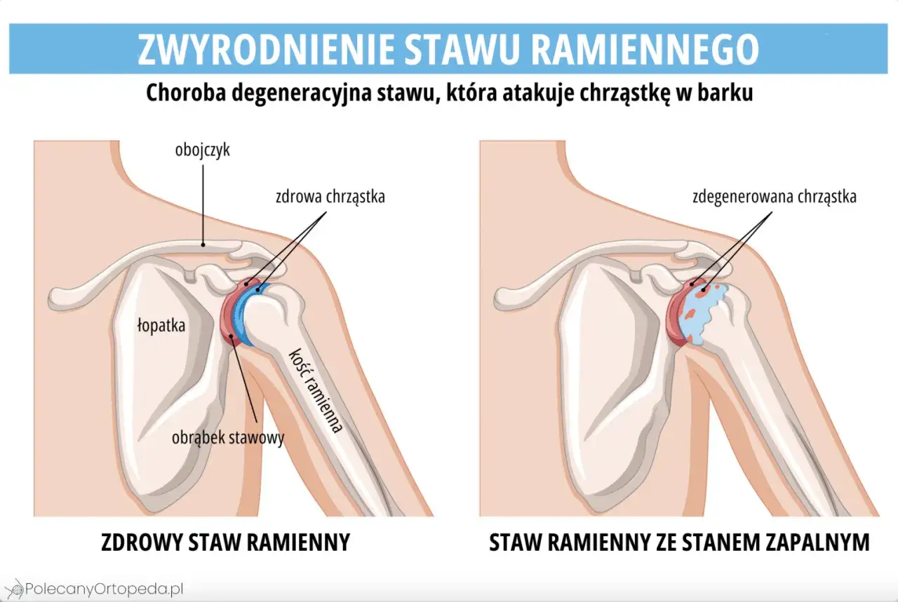 Porównanie zdrowego stawu ramiennego z degeneracją chrząstki, która powoduje ból stawów.