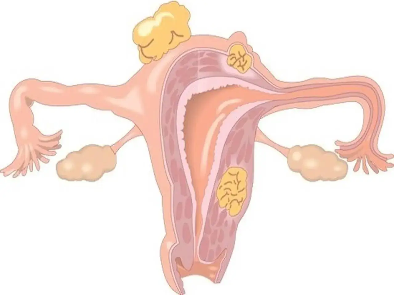 Anatomia kobieca z widocznymi mięśniakami macicy. Widoczny tyłozgięcie macicy.
