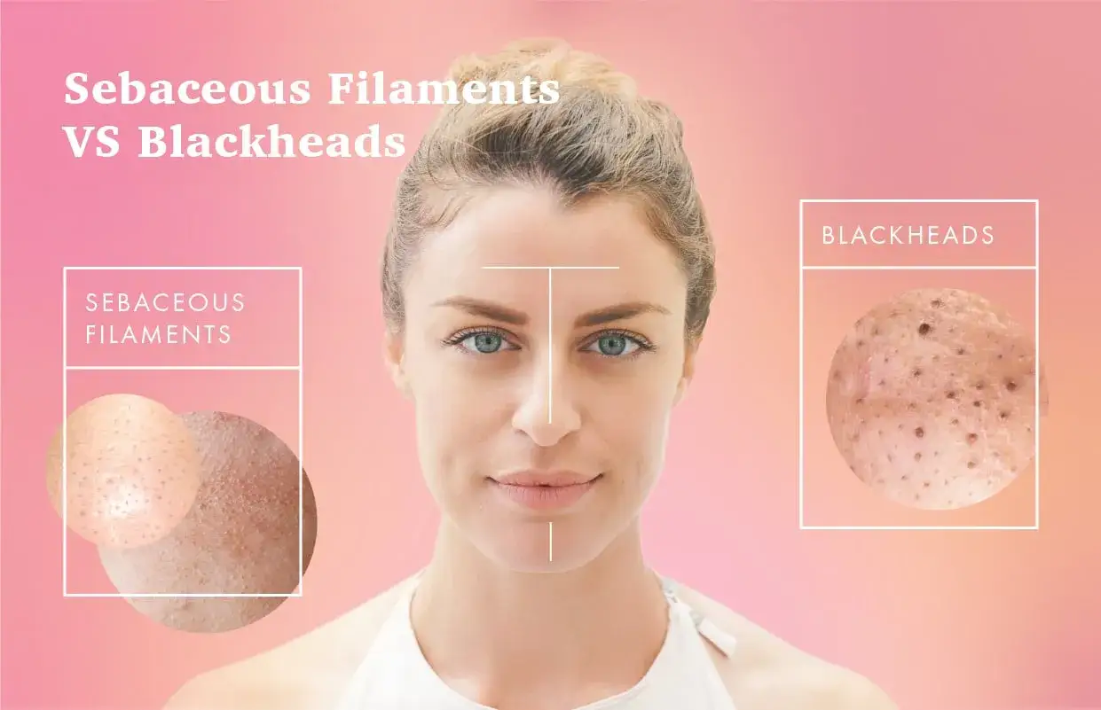 Comparaci&oacute;n visual de filamentos seb&aacute;ceos y puntos negros en la piel.