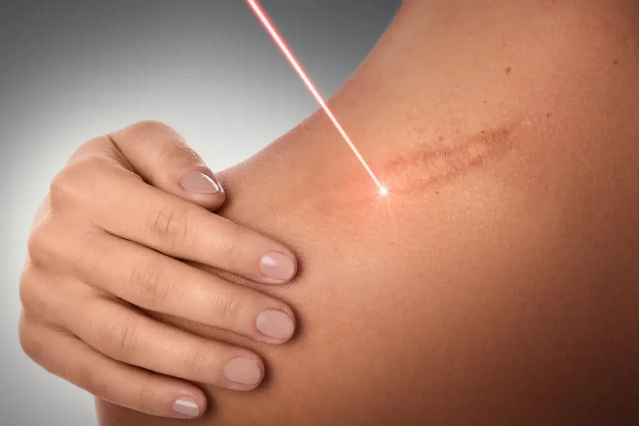 Czerwony promień lasera skupia się na bliznach po depilacji laserowej na skórze ramienia. Dłoń delikatnie dotyka miejsca zabiegu.