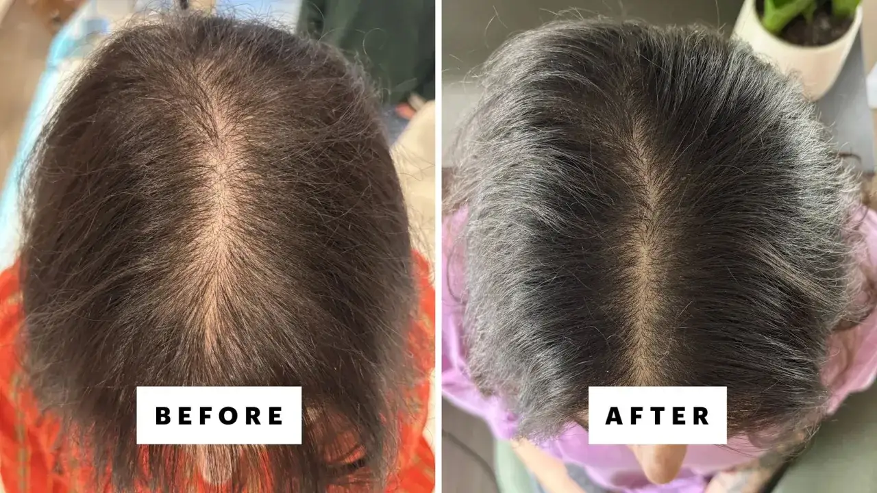 Comparaci&oacute;n de cabello antes y despu&eacute;s del tratamiento para efluvio tel&oacute;geno con minoxidil. Se observa mayor densidad capilar.