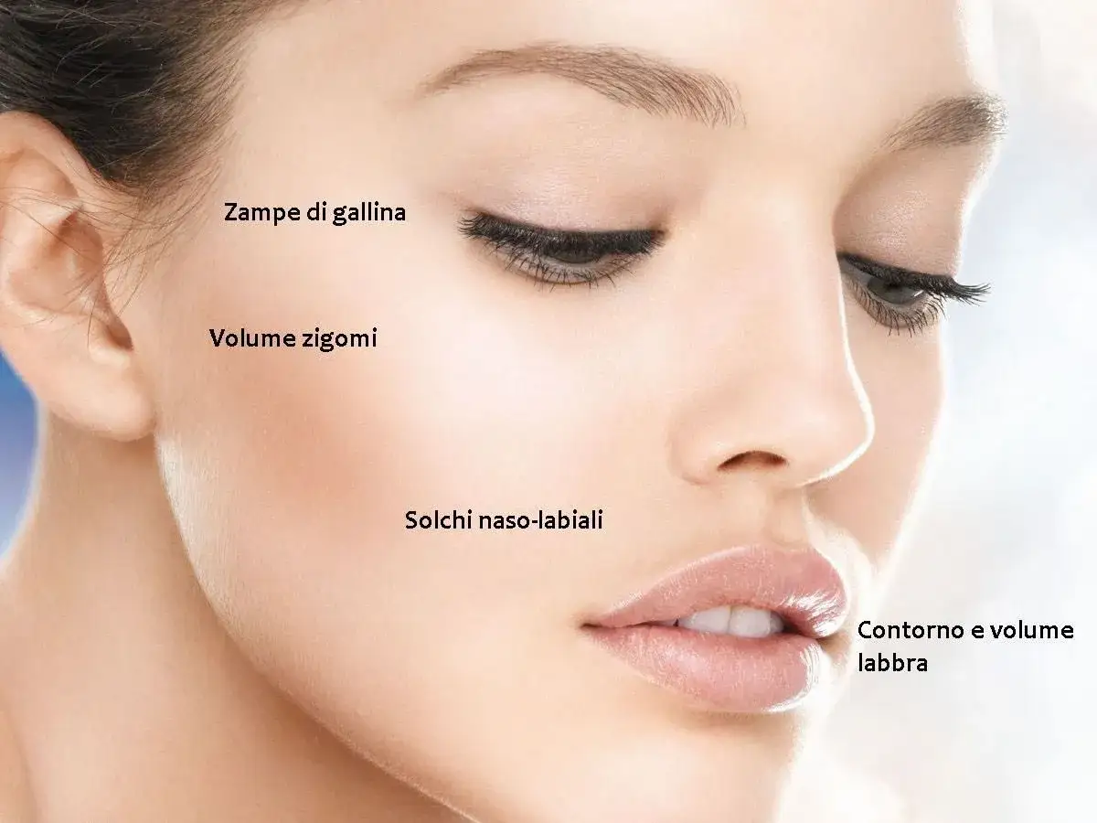 Volto femminile con indicazioni su come rimpolpare il viso: zigomi, labbra, zampe di gallina e solchi naso-labiali.