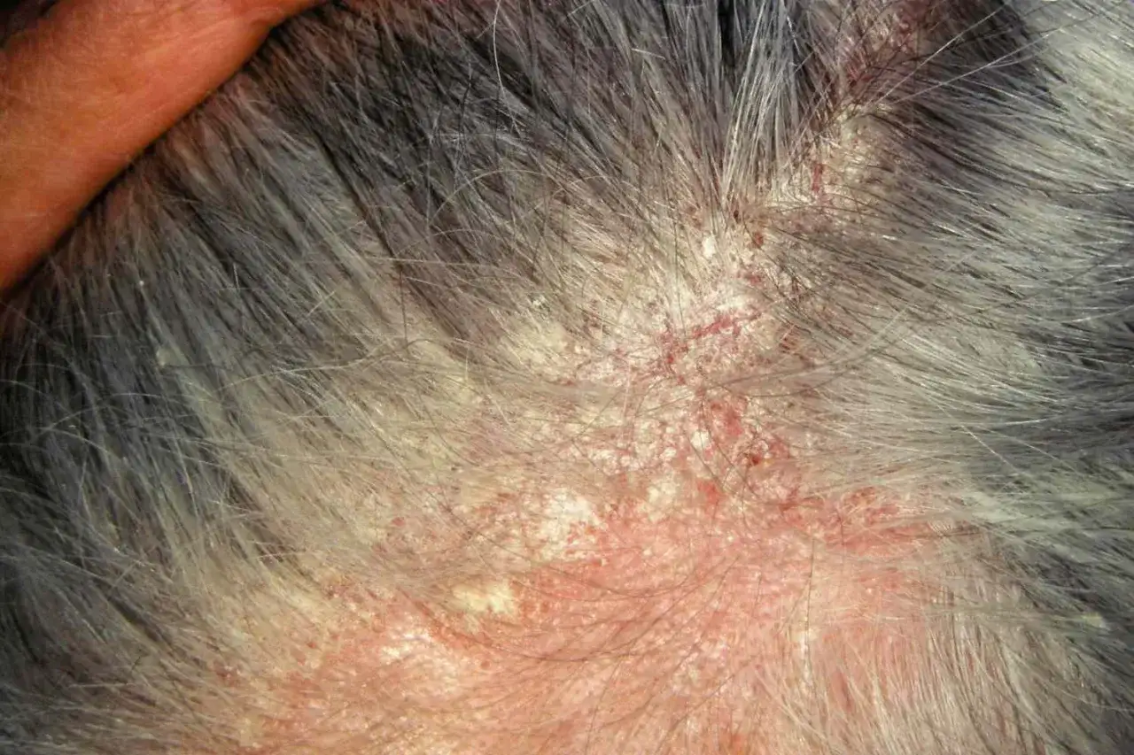 Cuir chevelu irrité avec des plaques rouges et squameuses, suggérant un danger potentiel lié à des produits comme Aminexil.